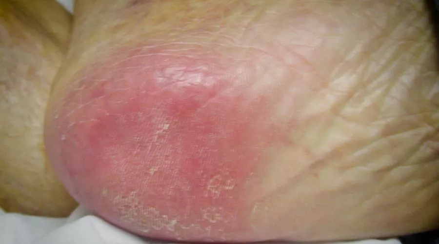 Check Your Skin For Signs Of Pressure Sores